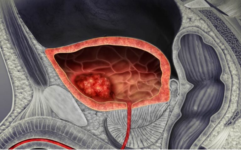 cancer-vejiga