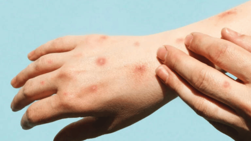 La OMS mantiene la emergencia sanitaria internacional por el rebrote de mpox - Imagen